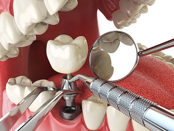 Best Urgent Tooth Repair  in Walce Ridge, LA
